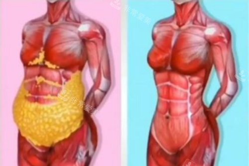 腹部脂肪消除卡通圖