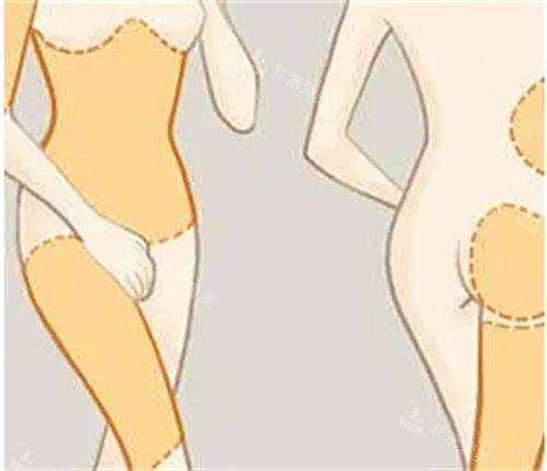 吸脂手術(shù)前后對(duì)比圖