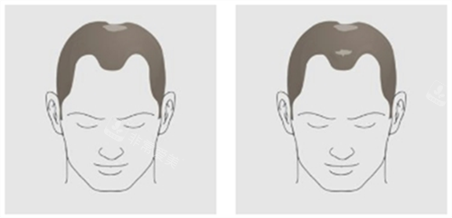 无锡艺植植发怎么样，专注毛发种植修复|方案定制合理|改善脱发问题结果可观！