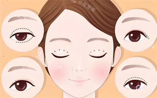 雙眼皮修復手術卡通展示圖