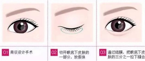 卧蚕手术步骤