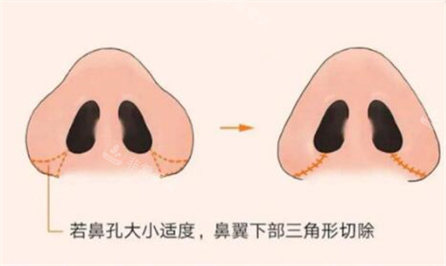 鼻翼縮小改善照片