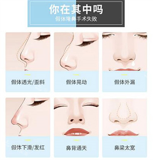 哪些鼻子需要做修復(fù)改善 哪些鼻子需要做修復(fù)改善