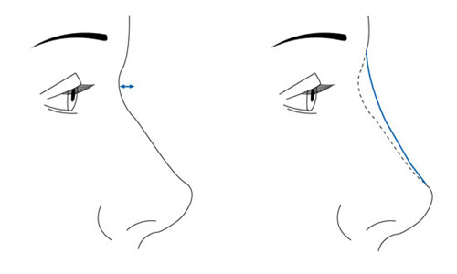 隆鼻手術(shù)前后對(duì)比 隆鼻手術(shù)前后對(duì)比