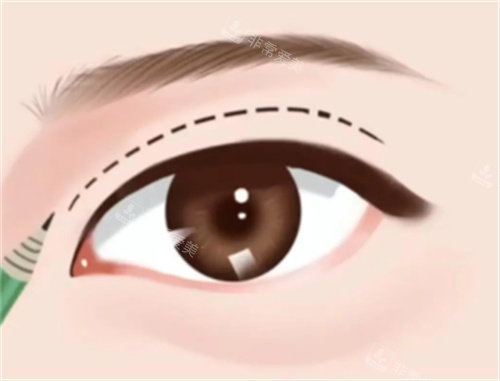 全切雙眼皮手術(shù)卡通圖片