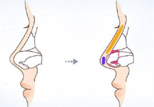 鼻尖鼻梁隆鼻手術(shù)前后對(duì)比圖