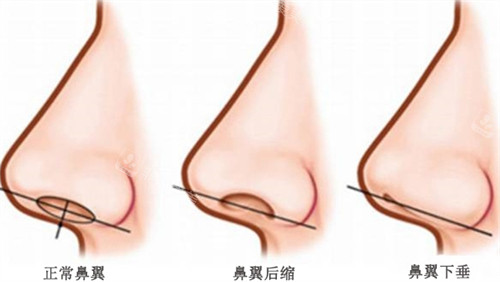 不同鼻翼對比