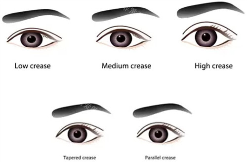 不同類型的雙眼皮 不同類型的雙眼皮