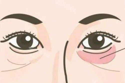 成都去眼袋醫(yī)生哪個好...