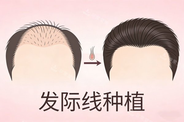 發(fā)際線種植前后對(duì)比圖展示