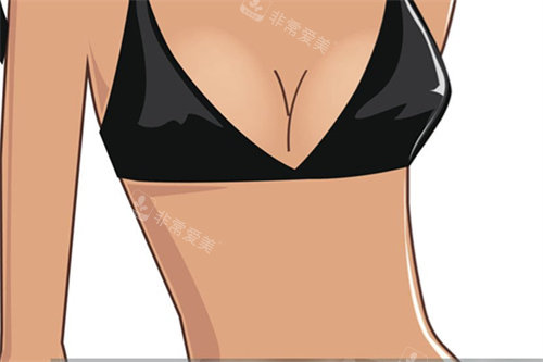 隆胸手術(shù)卡通宣傳圖