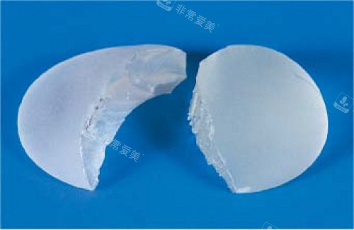 隆胸假體破裂后