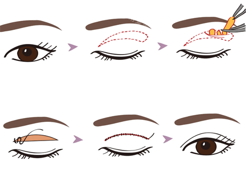 雙眼皮手術展示