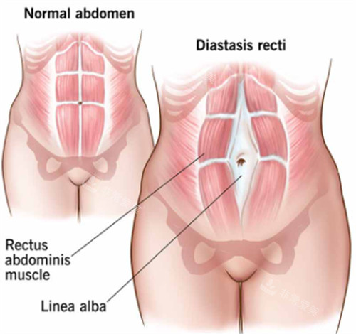 腹壁成形手術(shù)前后對(duì)比圖一覽