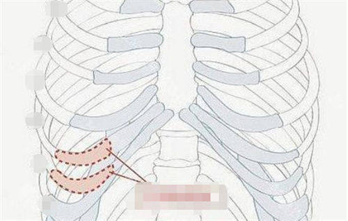 肋軟骨隆鼻肋部位置展示圖