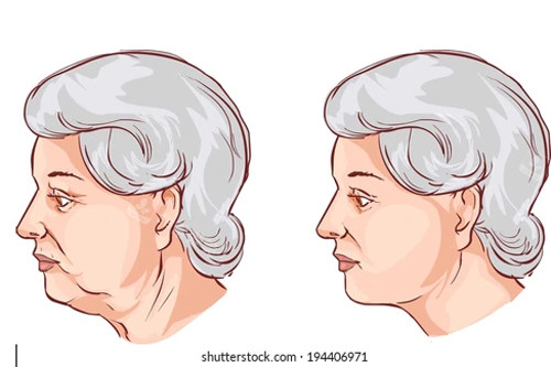 頸部拉皮卡通圖