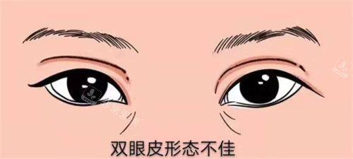 雙眼皮修復(fù)示圖