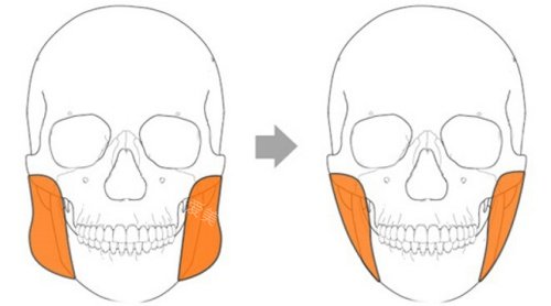 咬肌切除手術(shù)前后示意圖
