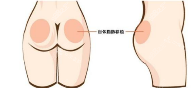 臀部塑形手術(shù)