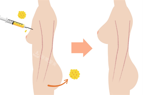 脂肪隆胸卡通圖