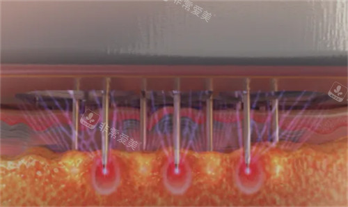 黑曜雙波黃金微針怎么樣