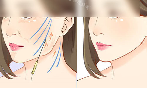 拉皮手術(shù)成效示意圖