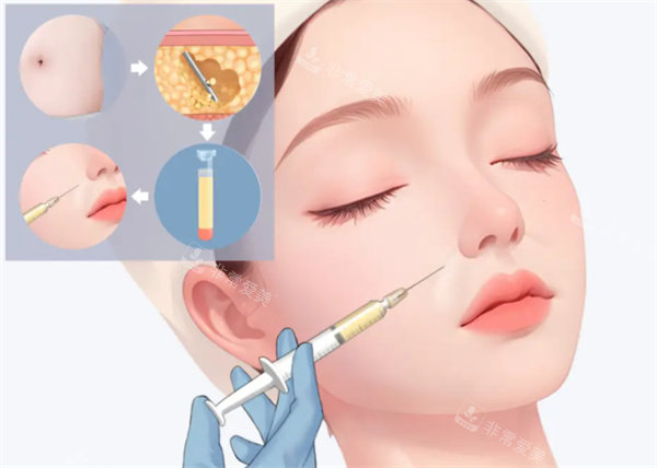 自體脂肪填充整形手術(shù)圖片