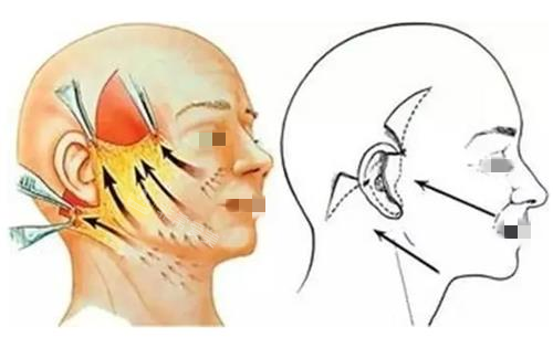 拉皮手術縫合前后示意圖