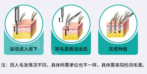 植發(fā)過程示意圖片