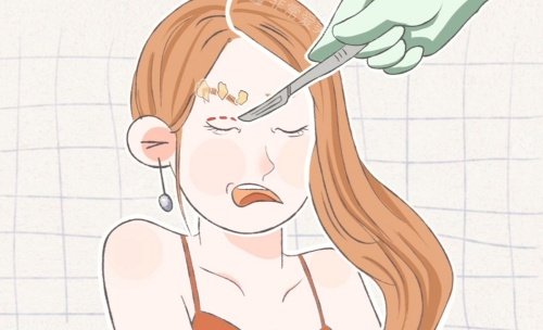 拉雙眼皮示意圖