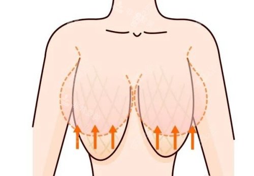 縮胸形態(tài)示意圖