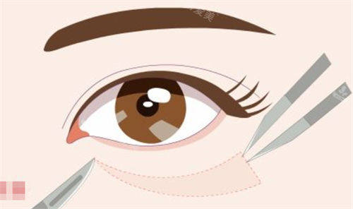 去眼袋手術(shù)示意圖