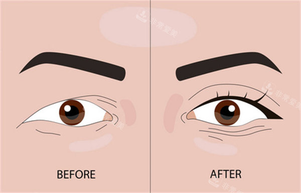 埋線雙眼皮整形