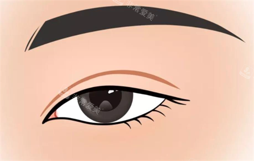 雙眼皮手術(shù)