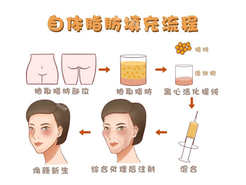 网评韩国脂肪修复医院排名公布！365mc|梦想整形|必妩整形外科技术实力与修复优势全解析！