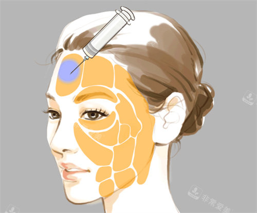 面部注射部位卡通圖