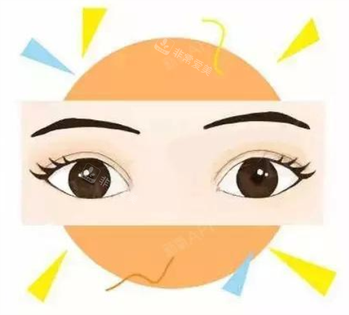 全切雙眼皮效果圖