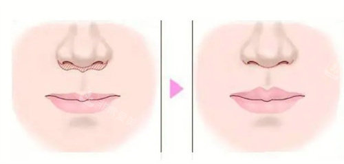 人中太長(zhǎng)