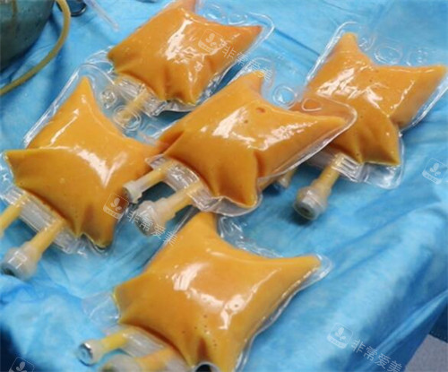 劉成勝脂肪豐胸展示圖