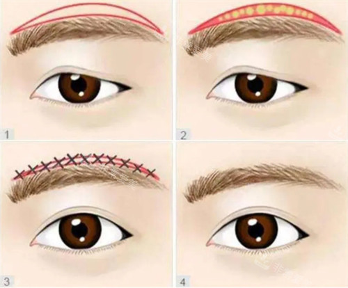 提眉是怎么做的