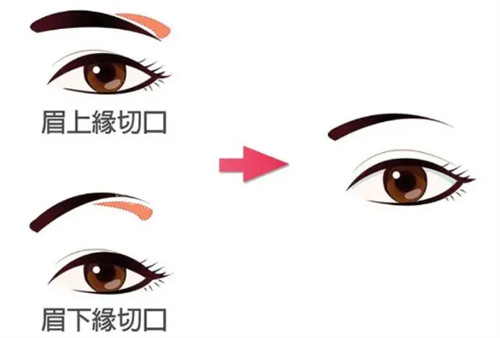 提眉的不同切口參考
