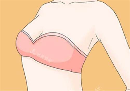 隆胸術(shù)后成效圖