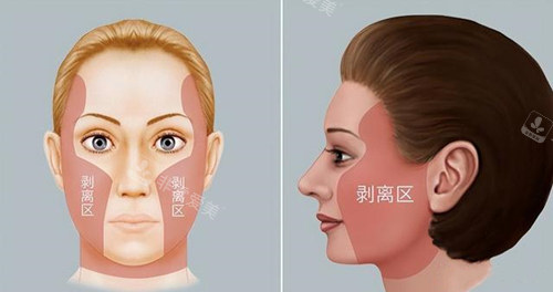 拉皮手術(shù)剝離區(qū)