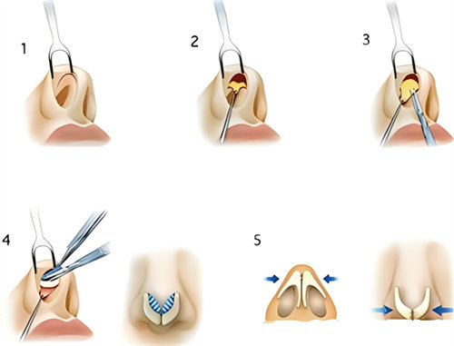膨體隆鼻過(guò)程