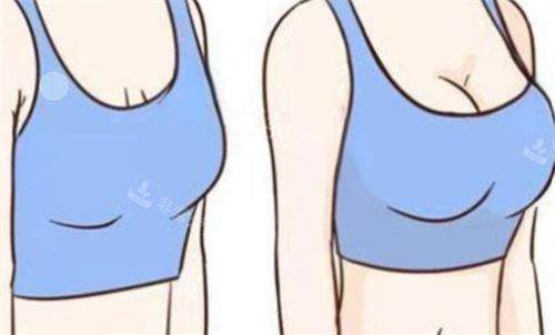 隆胸前后對比圖