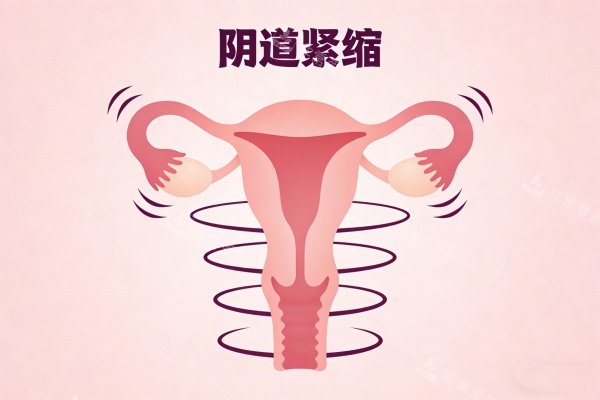 陰道緊縮卡通圖展示