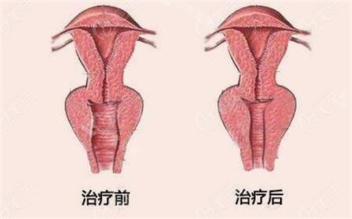 女性陰道緊縮手術(shù)前后對(duì)比動(dòng)畫圖