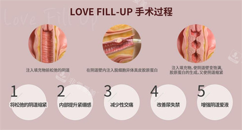 韓國(guó)信所愛(ài)女性醫(yī)院陰道注射