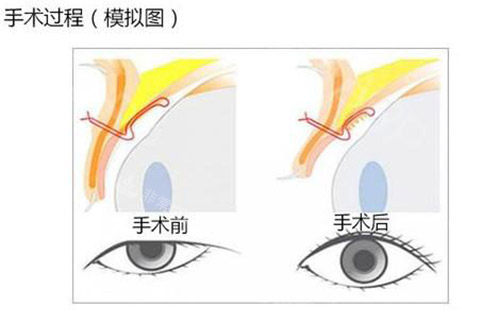 眼提肌手术照片 眼提肌手术照片