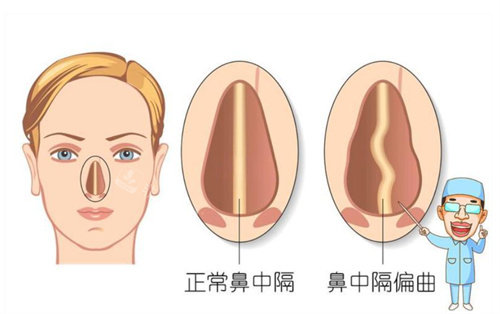 鼻中隔卡通展示图 鼻中隔卡通展示图